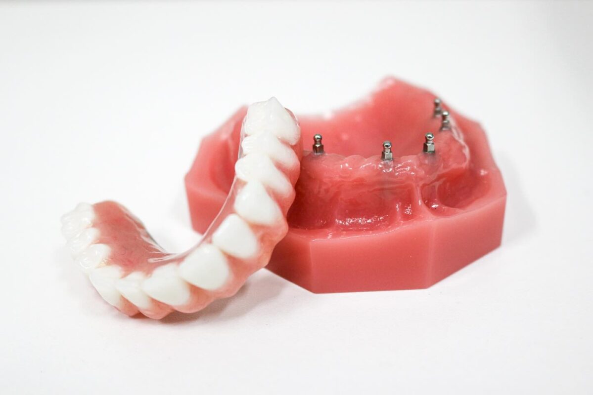 Pittsburgh Dental Implants | Affordable Mini Implants Near Me