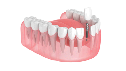 Payment Plans for Dental Implants in Butler, PA | Affordable Implant Crowns