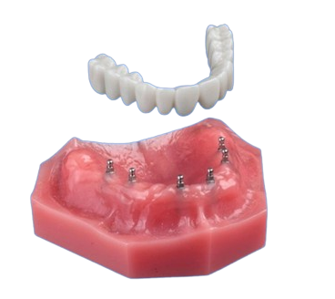 Roundhouse Dental Bridge in Butler, PA | Secure Your Smile With Mini Implants
