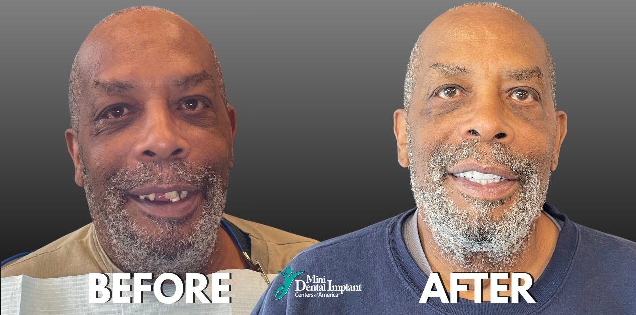 Before & After Smile Transformation with Mini Dental Implants at Brockley Dental Center in Butler, PA