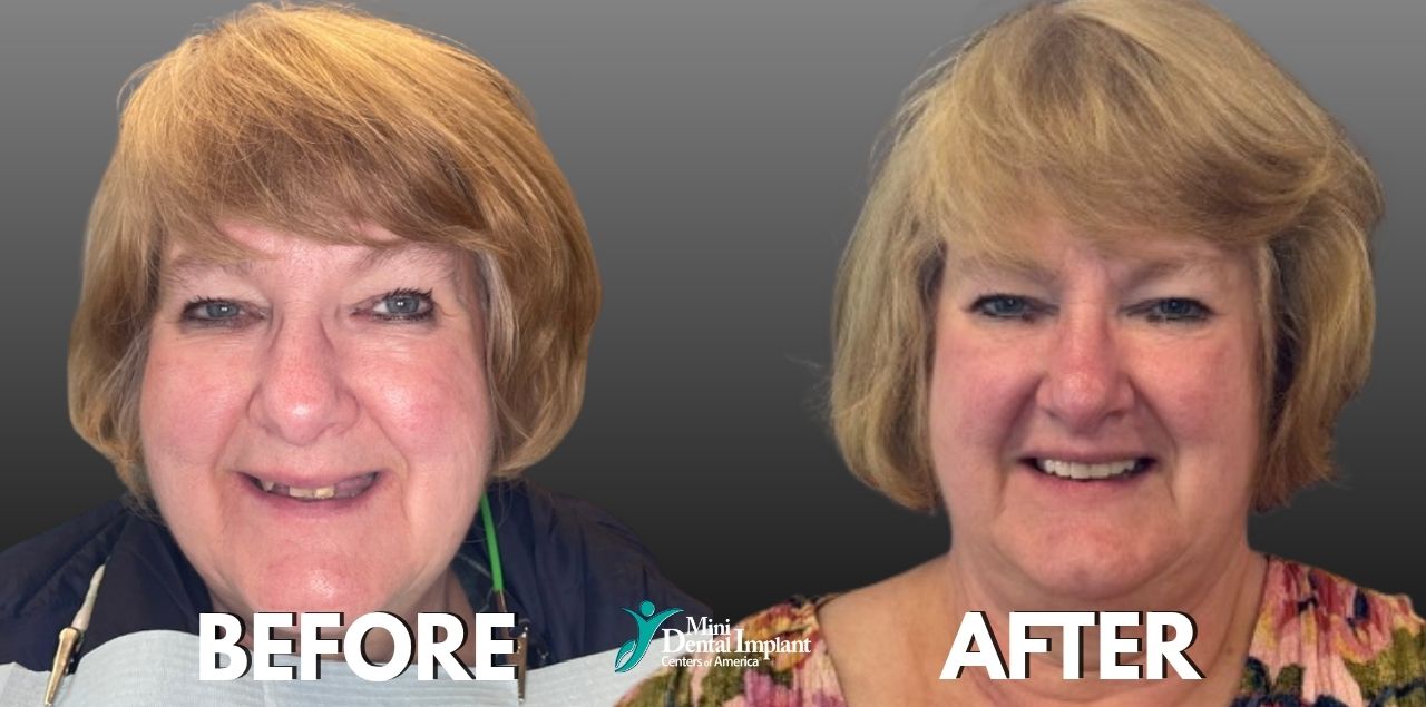 Before & After Smile Transformation with Mini Dental Implants at Brockley Dental Center in Butler, PA