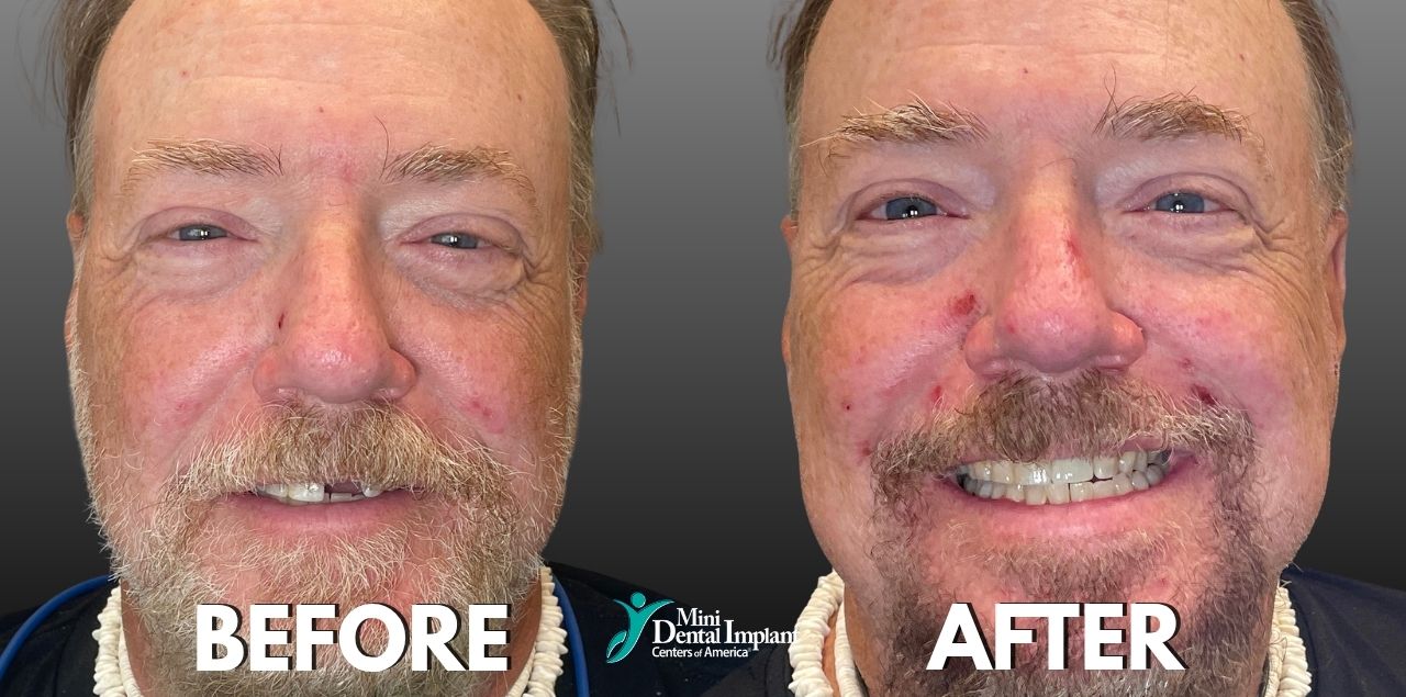 Before & After Smile Transformation with Mini Dental Implants at Brockley Dental Center in Butler, PA