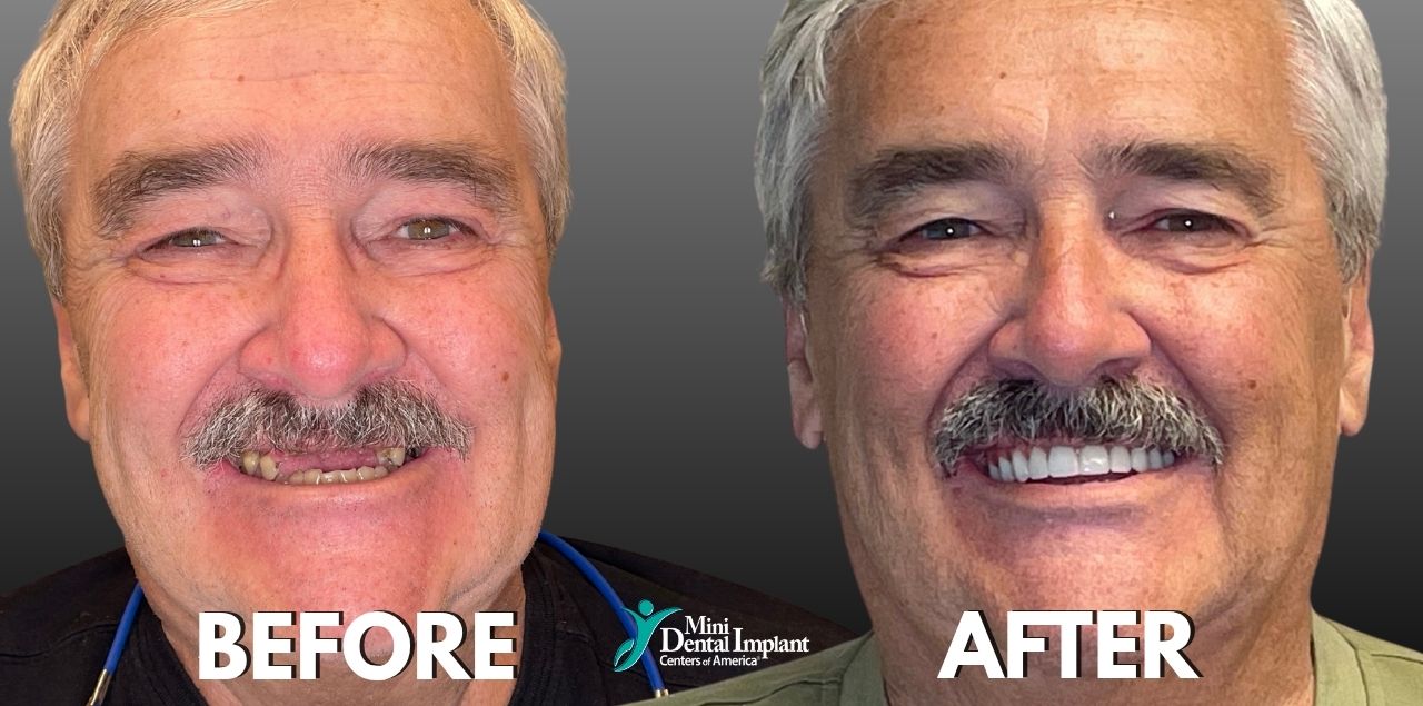 Before & After Smile Transformation with Mini Dental Implants at Brockley Dental Center in Butler, PA