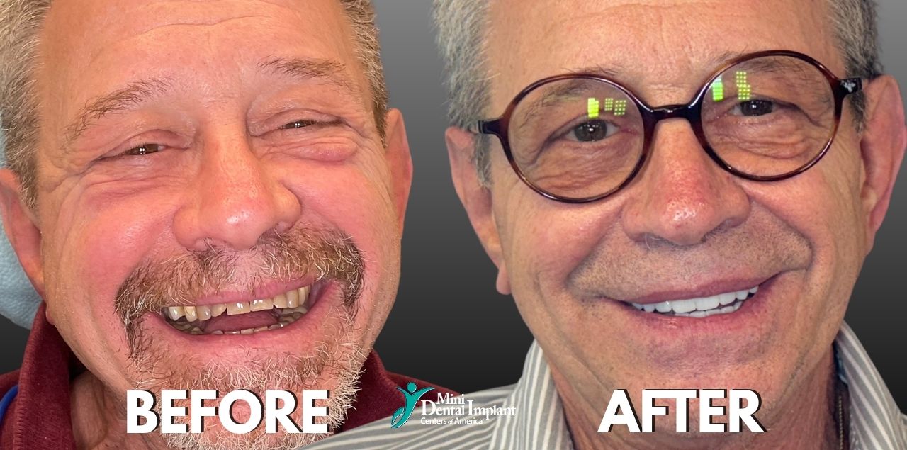 Before & After Smile Transformation with Mini Dental Implants at Brockley Dental Center in Butler, PA