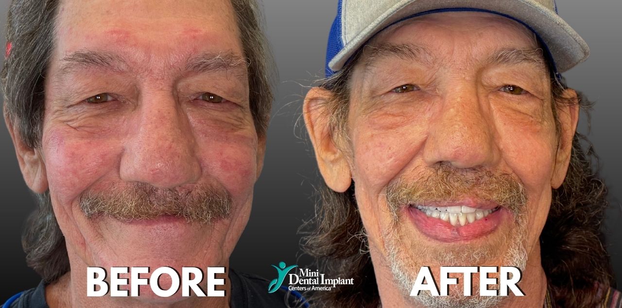 Before & After Smile Transformation with Mini Dental Implants at Brockley Dental Center in Butler, PA