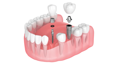 All on 6 Alternatives in Butler, PA | Mini Implants vs. Conventional Implants