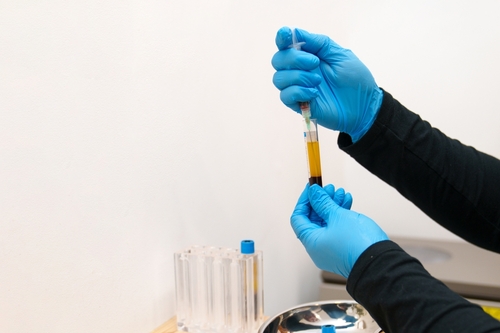 What Are the Benefits of L-PRF | Fast-Track Healing in Butler, PA!