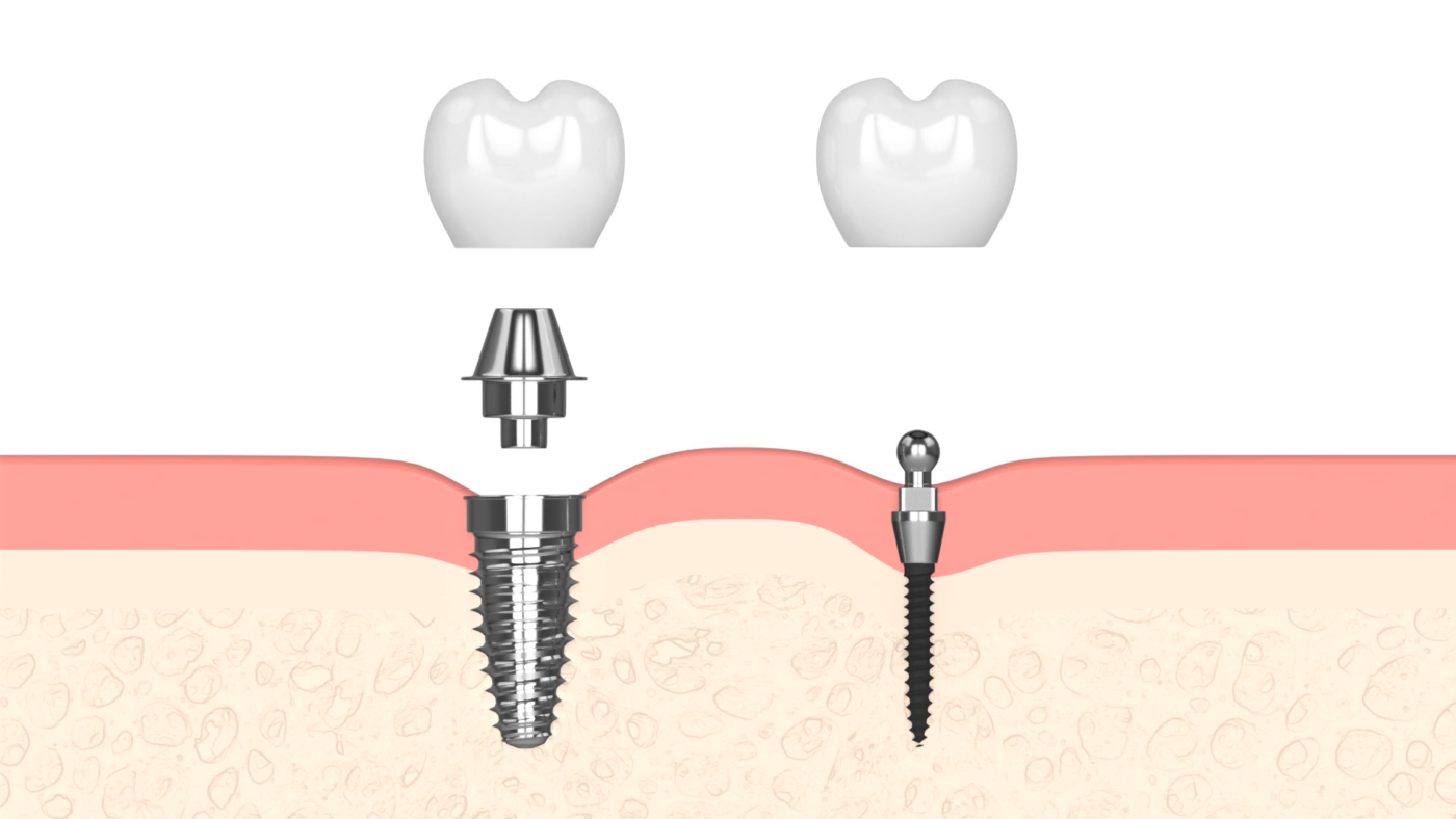 Mini Dental Implants vs Regular Implants? | Find Affordable Tooth Replacement in Butler, PA