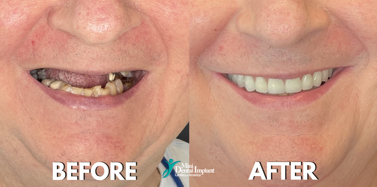 Before & After Smile Transformation with Full Arch Implant Bridge at Brockley Dental Center in Butler, PA
