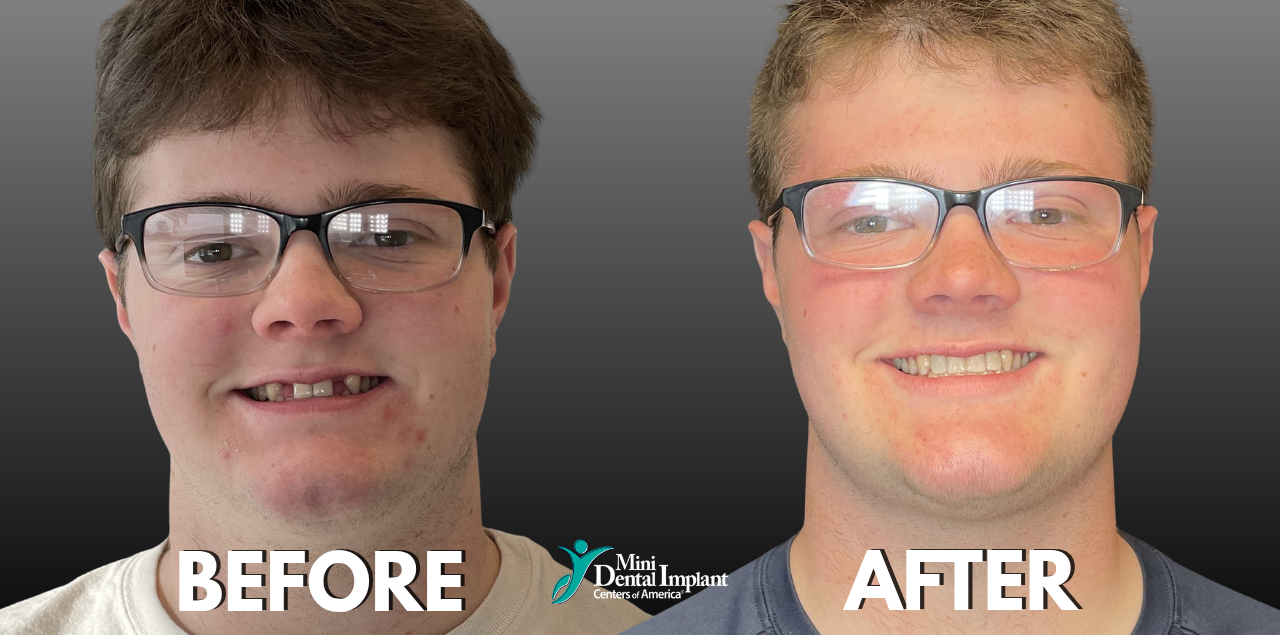 Before & After Smile Transformation with One-Piece Implants at Brockley Dental Center in Butler, PA