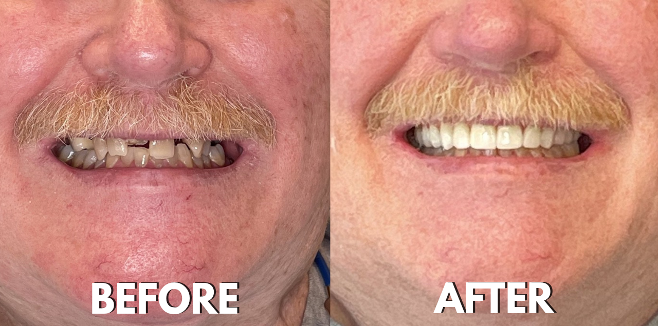 Before & After Smile Transformation with Roundhouse Implant Bridge at Brockley Dental Center in Butler, PA