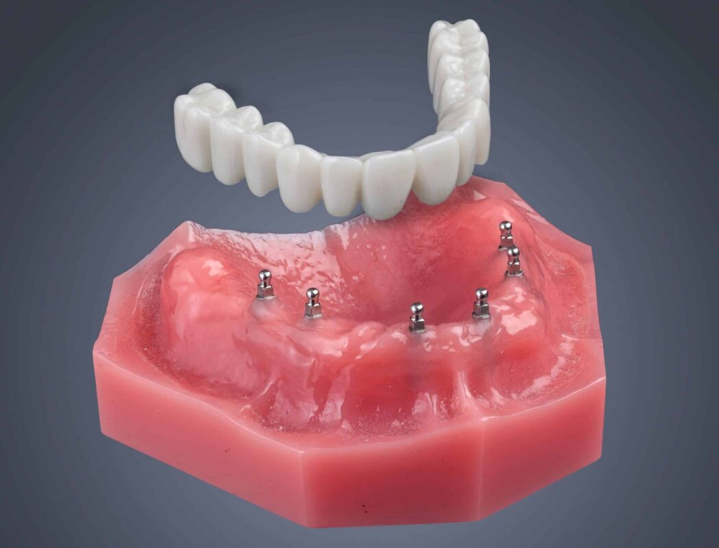 Roundhouse Dental Bridge Cost in Butler, PA [Video Explanation]
