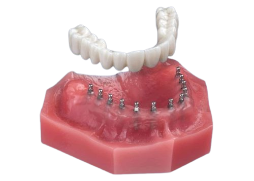Implant Bridge in Butler, PA [Video Inside] | Restore Your Smile