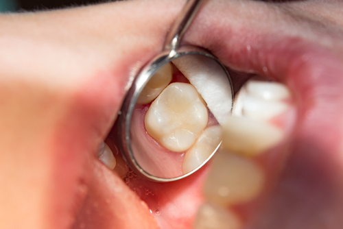 Root Canal Pain Relief in Butler, PA | Emergency Dental Care