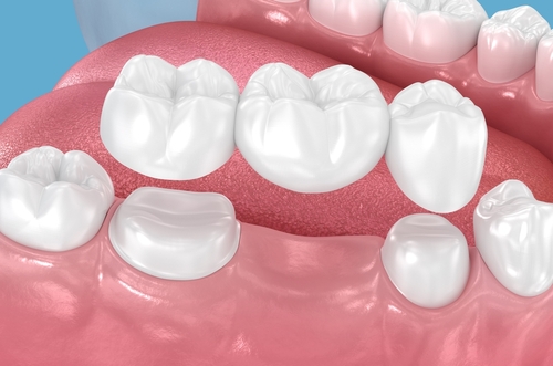 Dental Implant Alternatives in Butler, PA | Replace Missing Teeth With a Dental Bridge